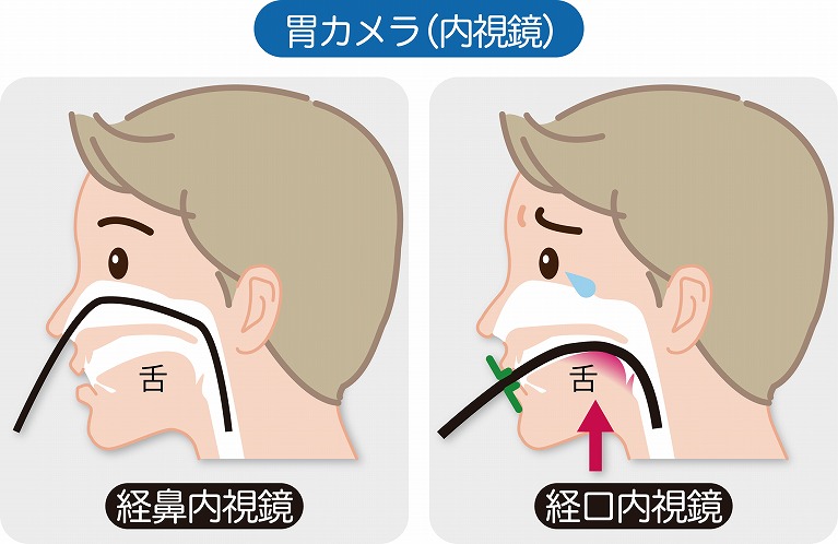 経口または経鼻内視鏡の選択が可能