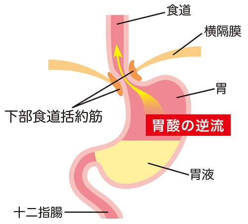 逆流性食道炎の原因はストレスが関係している！？