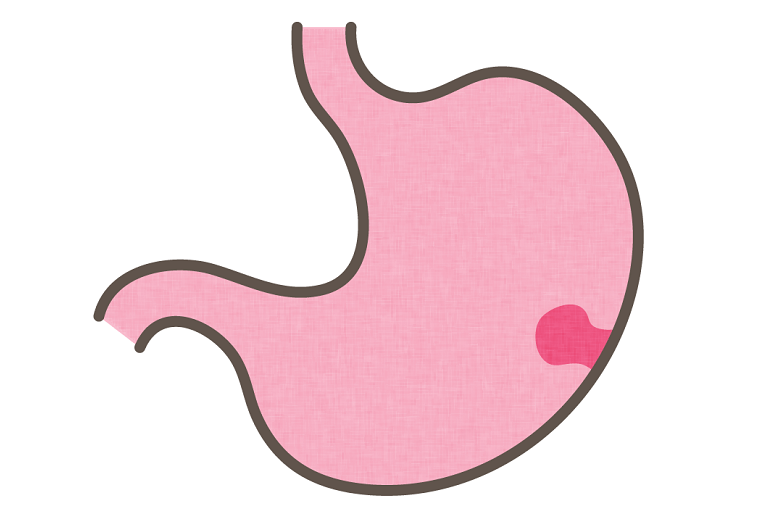 胃ポリープは切除するべき？がんになる可能性は？
