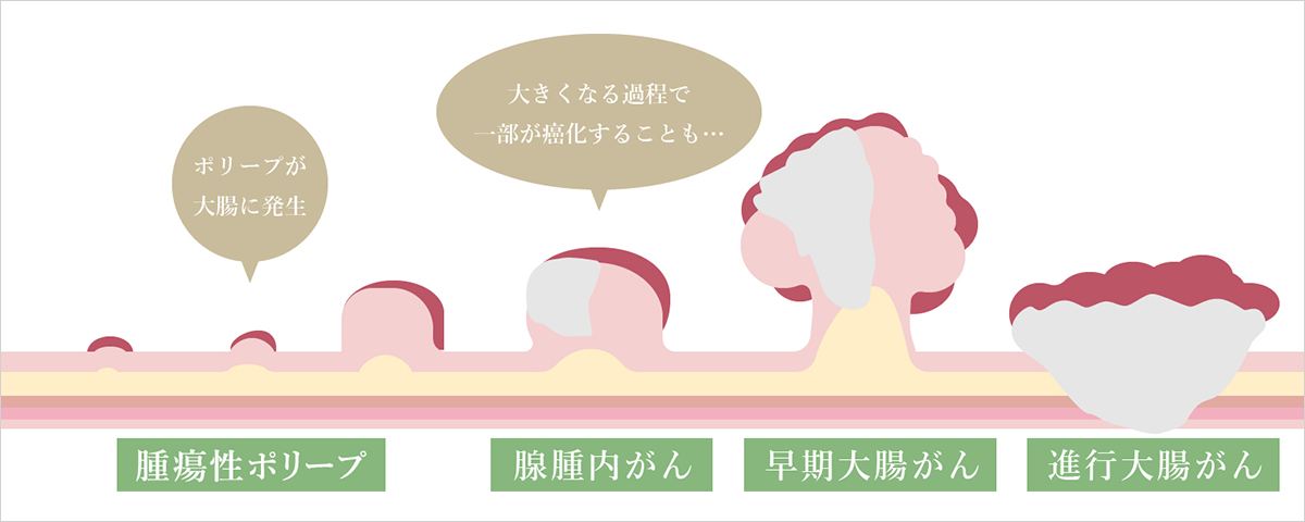どうやって大腸がんが出来るの？